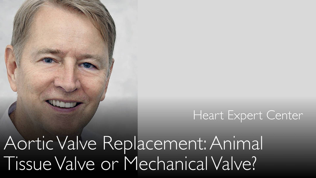 Remplacement valvulaire aortique : valvule biologique (porcine ou bovine) ou mécanique. Comment choisir ?