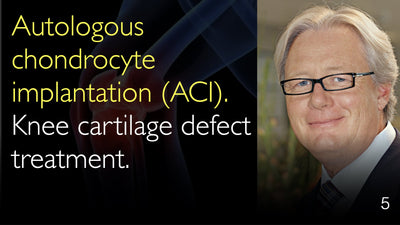 Autologous chondrocyte implantation (ACI). Knee cartilage defect treatment. 5